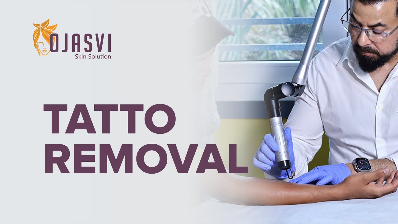 Safe & Effective Tattoo Removal – Dr. Tavi at Ojasvi Skin Clinic, Meerut