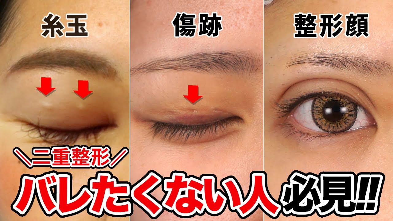 二重整形・埋没法がバレたくない人必見！！糸玉・傷跡・整形顔！？整形でもバレにくい二重を伝授！！