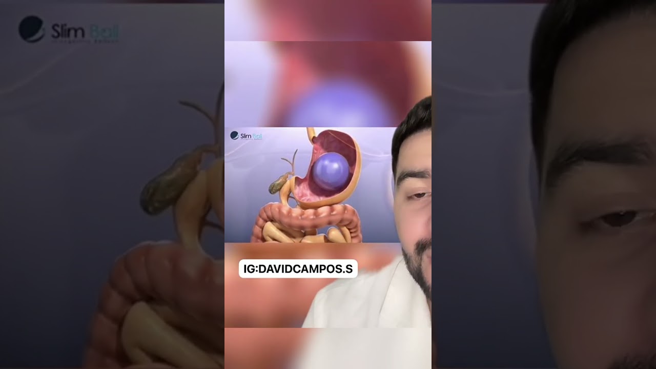 BALÓN GÁSTRICO PARA ADELGAZAR