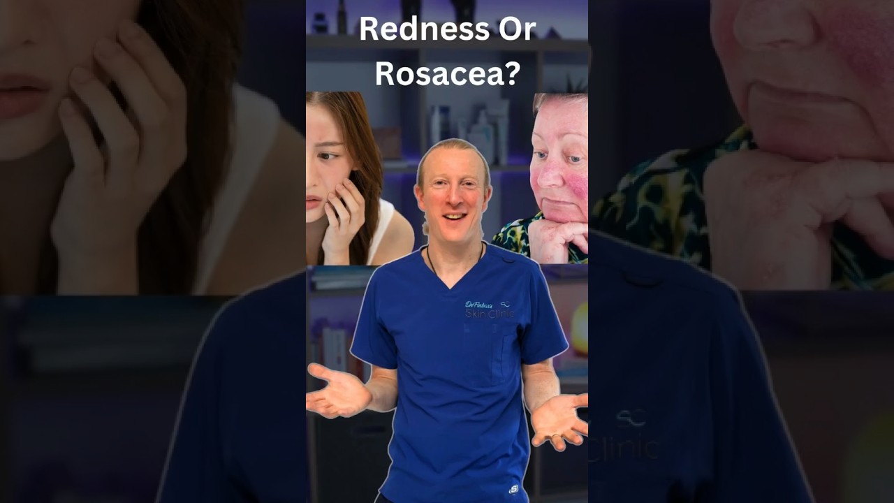Is it Sunburn, Blushing, or Rosacea? Here’s how to tell