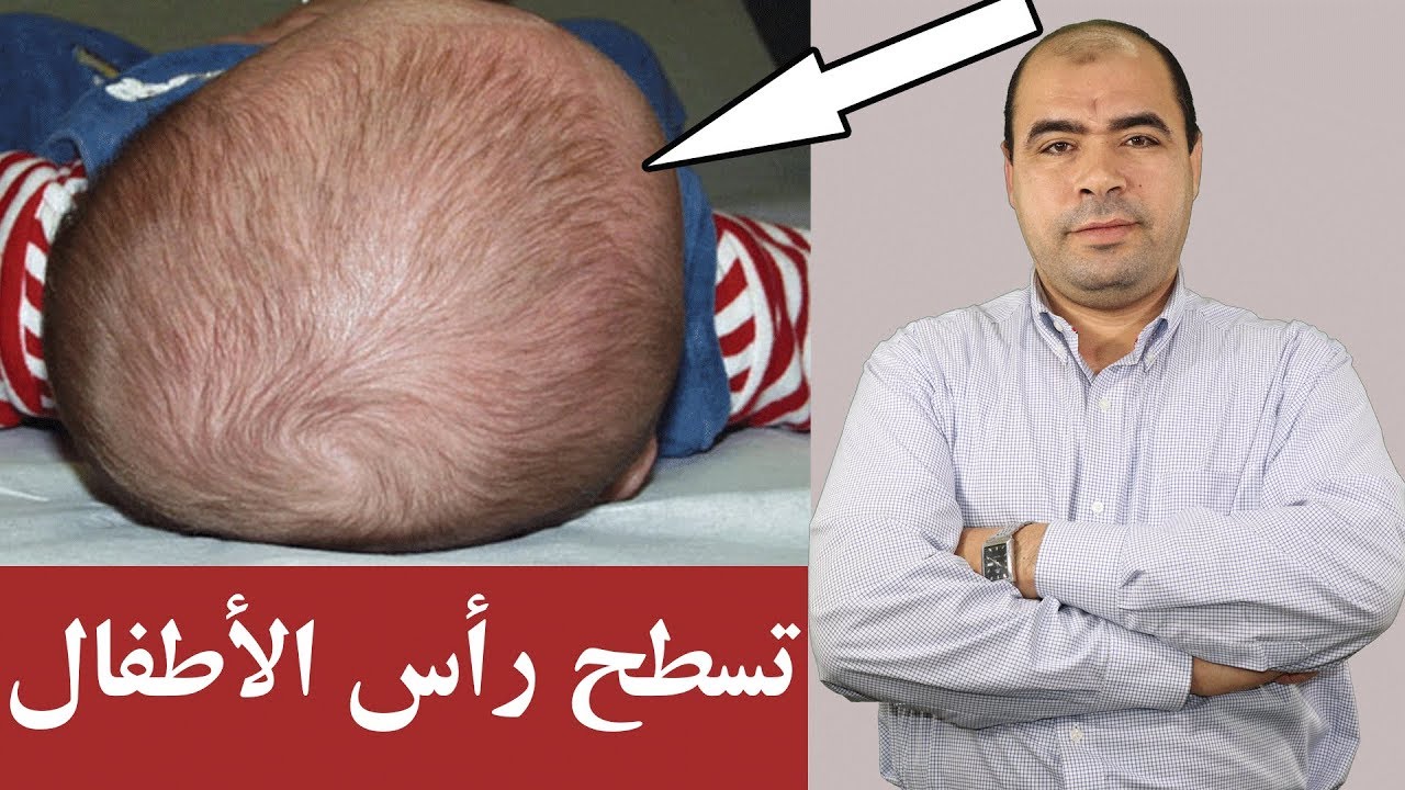 تسطح رأس الاطفال الاسباب والعلاج | Flat Head Syndrome