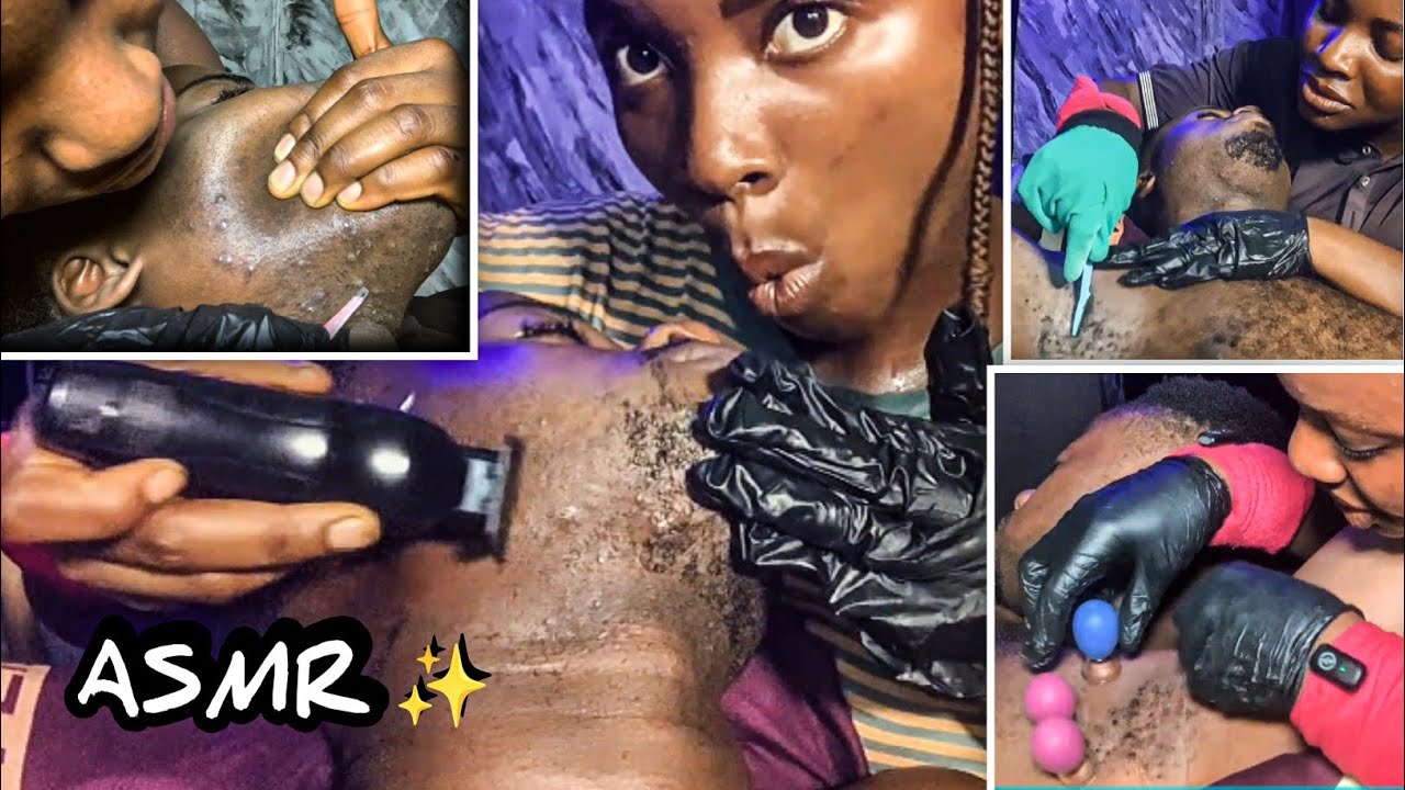 ASMR ✨ deep Beard nitpicking and armpit hair shaving#ingrown hair removal (50 min compilation video)