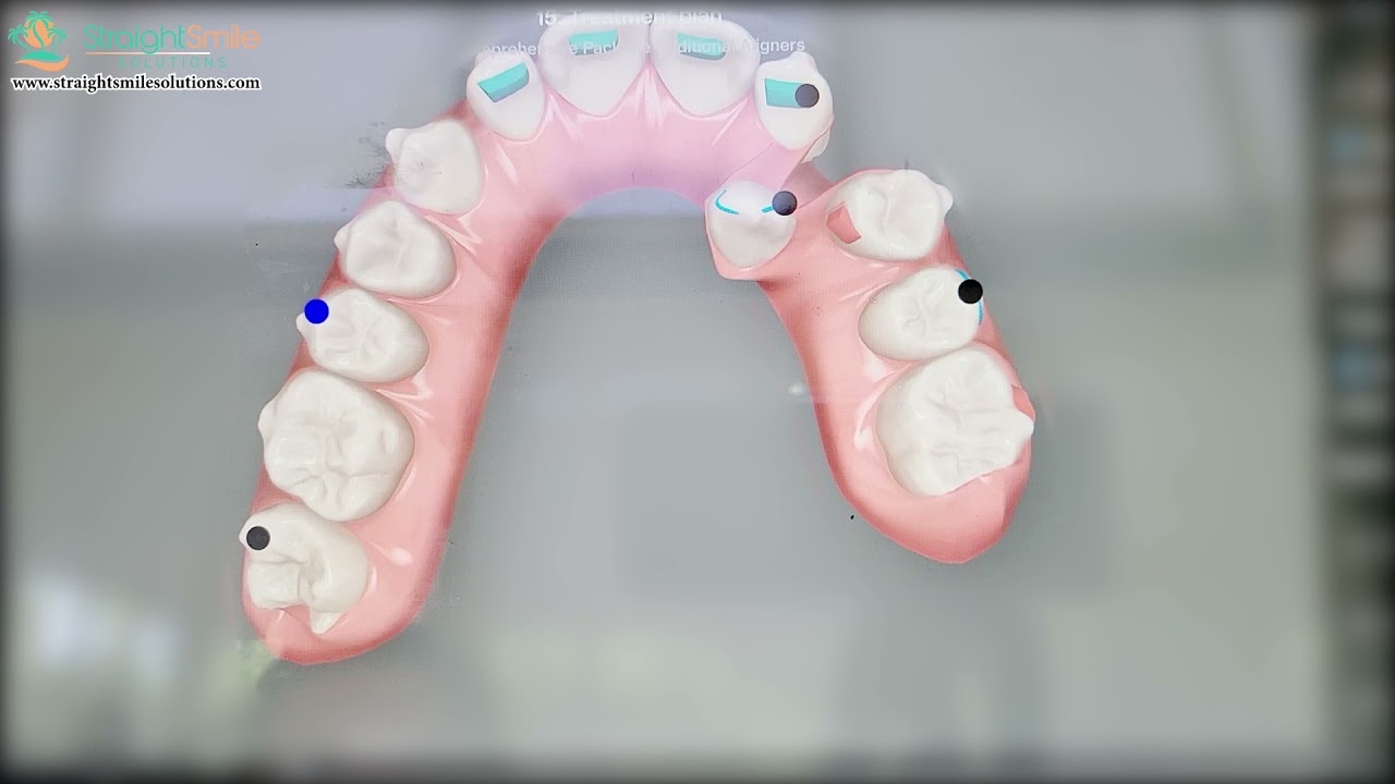 Invisalign for Impacted Canines- Progress ClinCheck