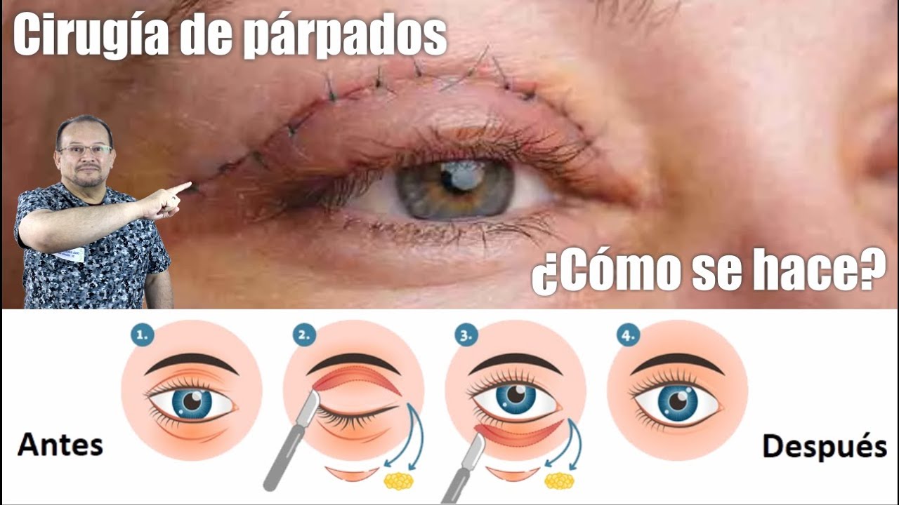 T&eacute;cnicas de BLEFAROPLAST&Iacute;A 👀 &iquest;C&oacute;mo se hacen las CIRUG&Iacute;AS de P&Aacute;RPADO? ⭐ Dr ALBERTO CALVO