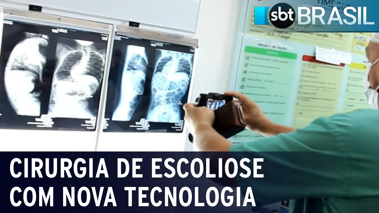 Primeira cirurgia para escoliose com tecnologia revolucionária é realizada | SBT Brasil (25/08/22)