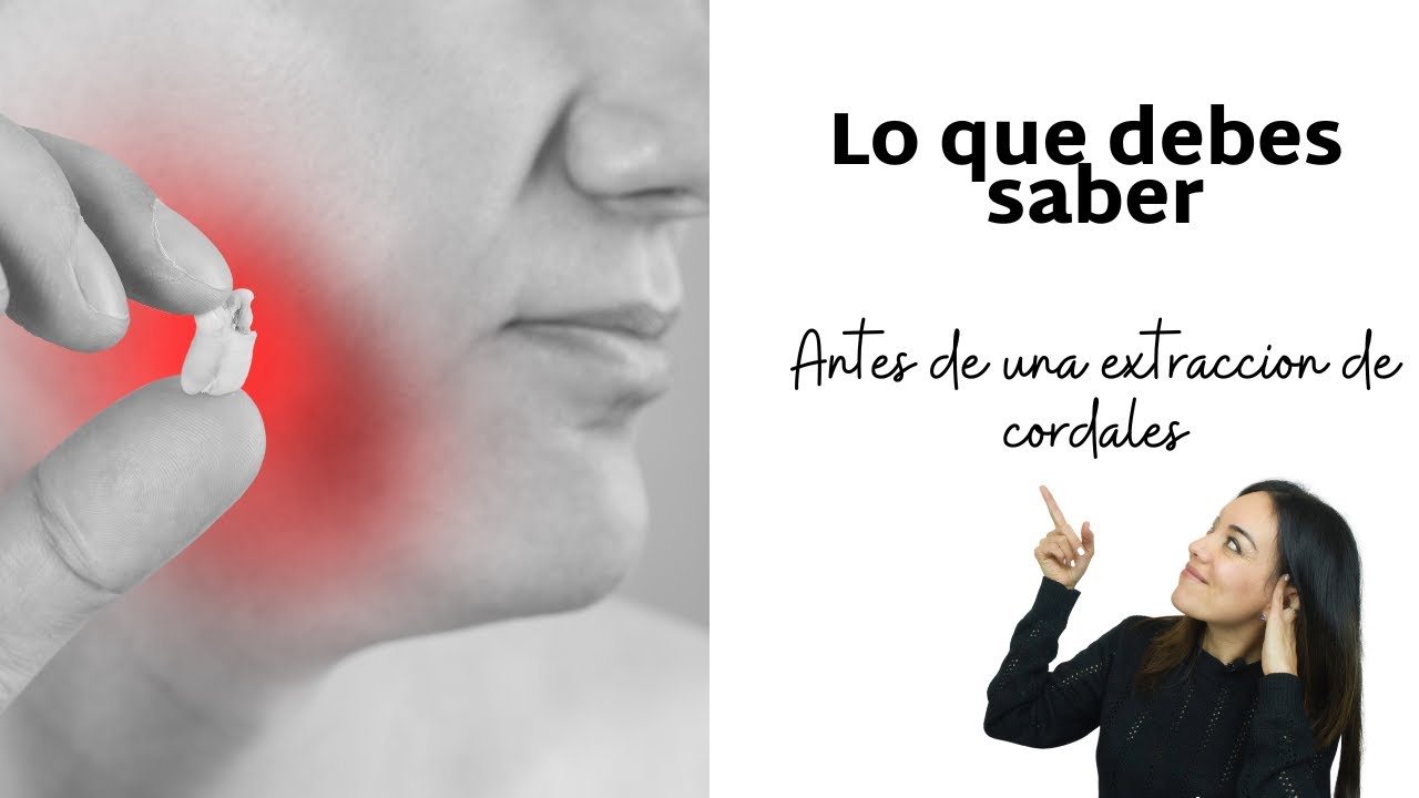 9 tips para la extraction de cordales - lo que tienes que saber antes de esta cirugía.