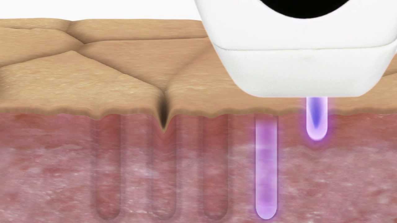 Tria SmoothBeauty Laser - How It Works - UK/CA l Tria Beauty&reg;