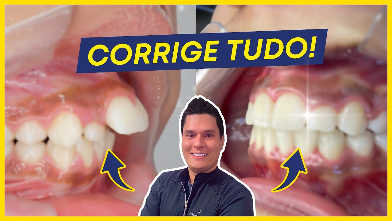 Como CORRIGIR DENTES PRA FRENTE com APARELHO ORTODÔNTICO?