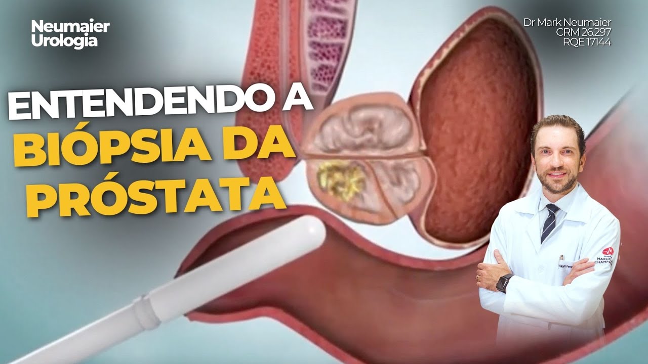 BIÓPSIA DA PRÓSTATA - animação