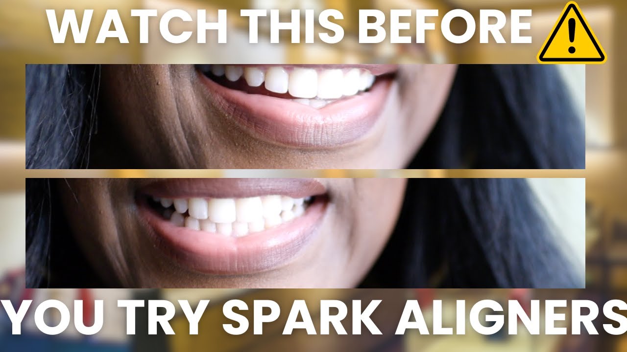Spark Aligner Rant- Watch Before You Get SPARK Aligner