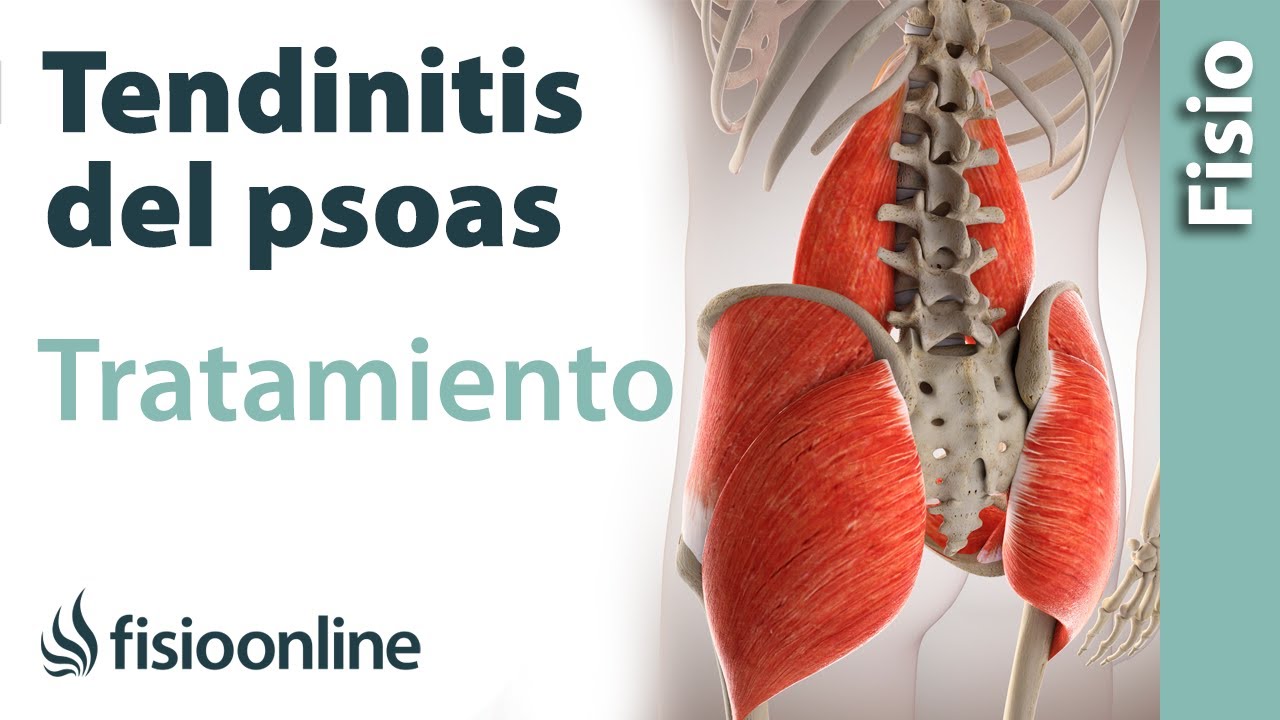 PSOITIS O TENDINITIS DEL PSOAS - Tratamiento con ejercicios, automasajes y estiramientos
