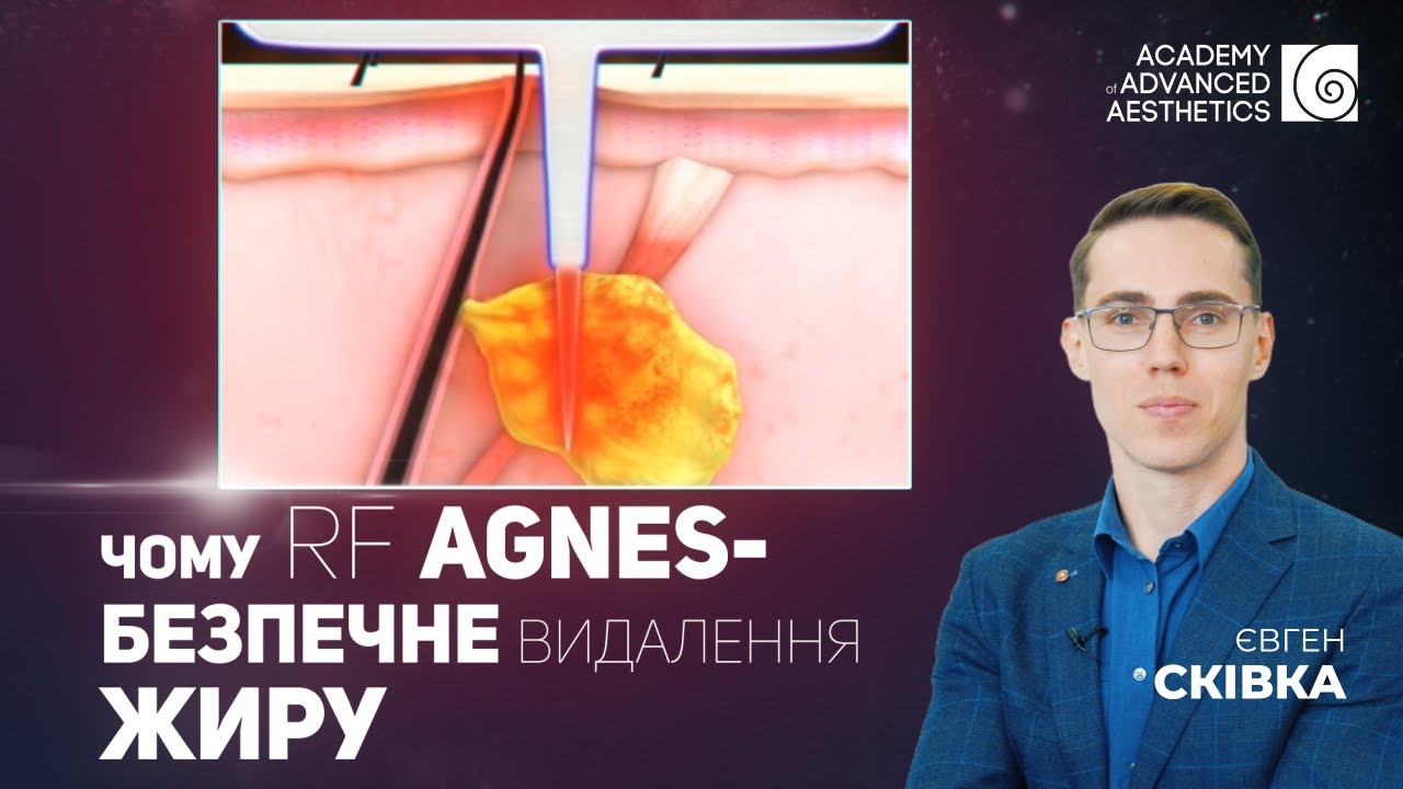 Чому RF AGNES це безпечне видалення жиру