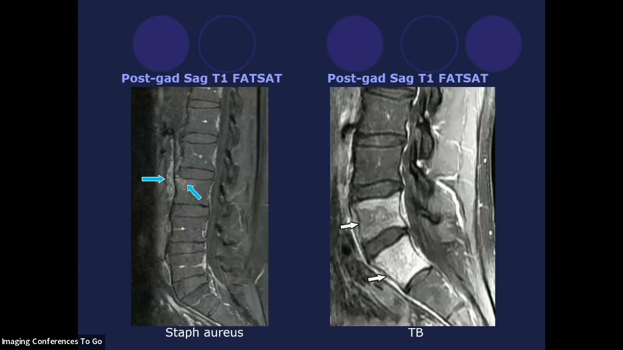 Spine Imaging -  Spine Infection Tips For Radiologists
