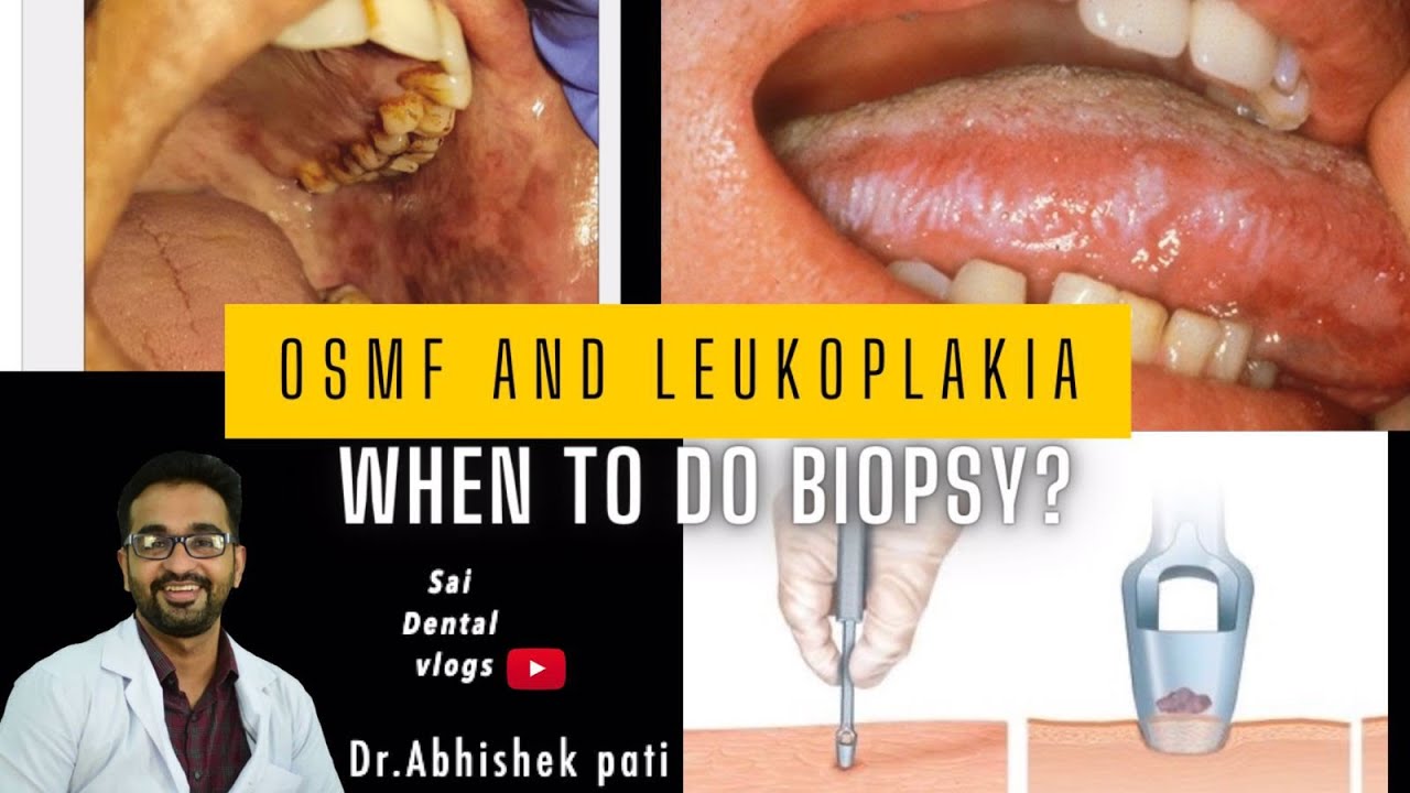 Osmf and leukoplakia- when to do biopsy
