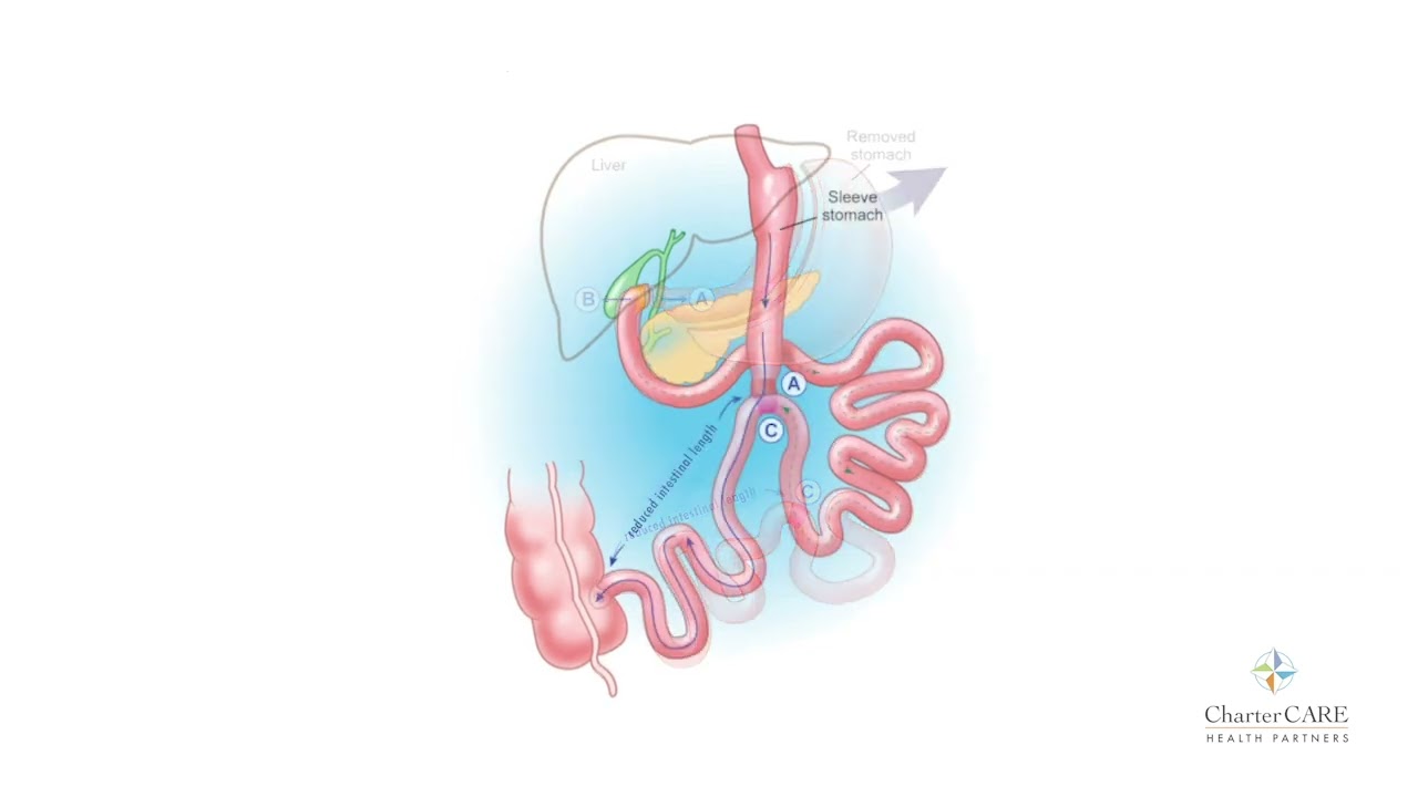 Duodenal Switch - Weight Loss Surgery Center at Roger Williams Medical Center