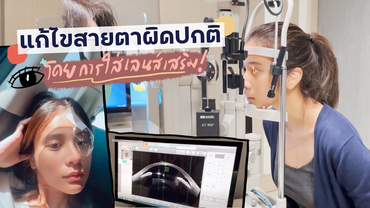 แก้ไขสายตาผิดปกติ โดยการใส่เลนส์เสริม(ICL)! | KaoSupassara