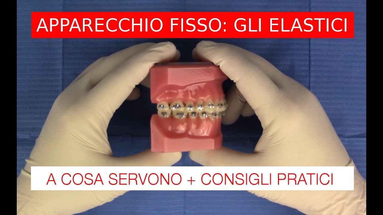 Elastici e apparecchio fisso: consigli pratici