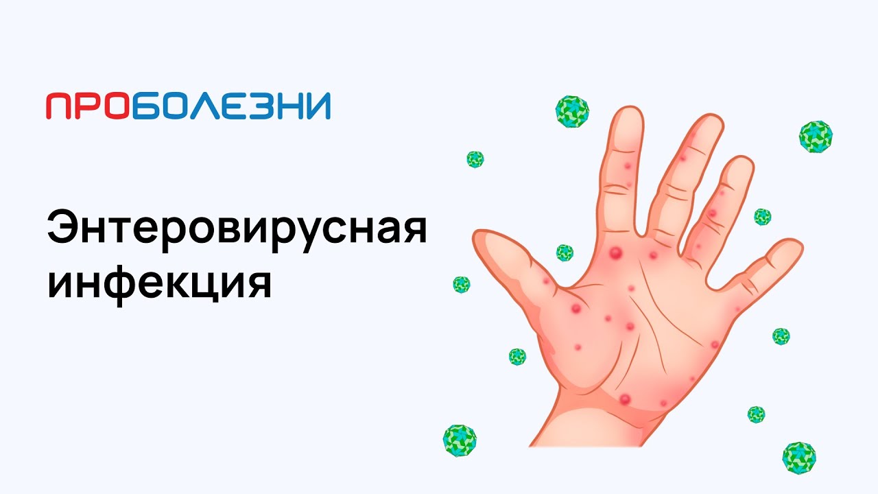 Энтеровирусная инфекция