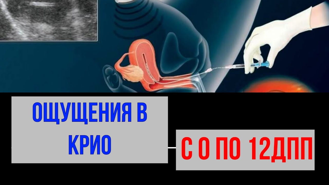 ЭКО. ОЩУЩЕНИЯ В КРИО С 0 по 12ДПП.Часть 2.Видео №12