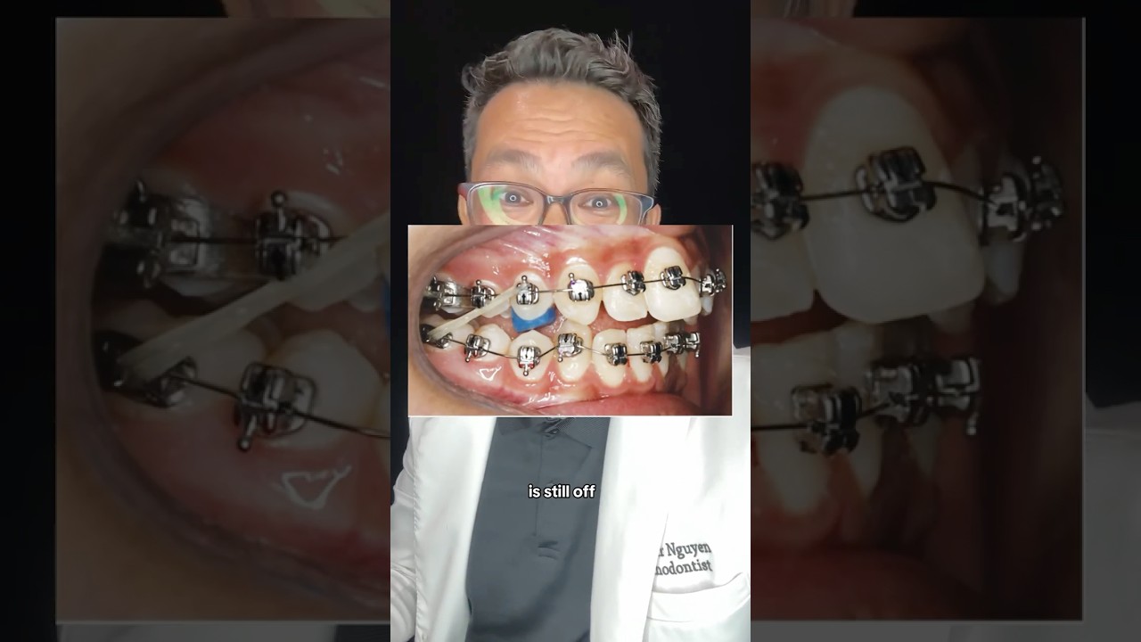 Reasons why you Still have those Braces on