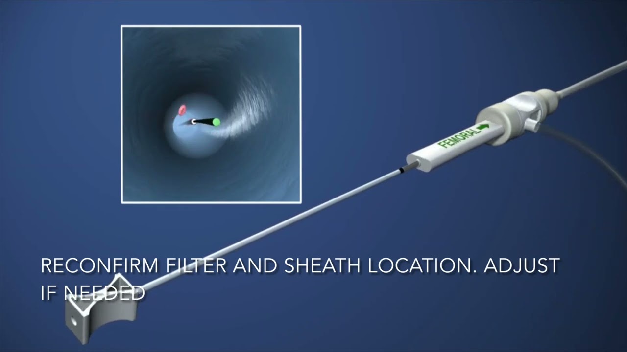 Argon Medical - Option Elite Standard Delivery