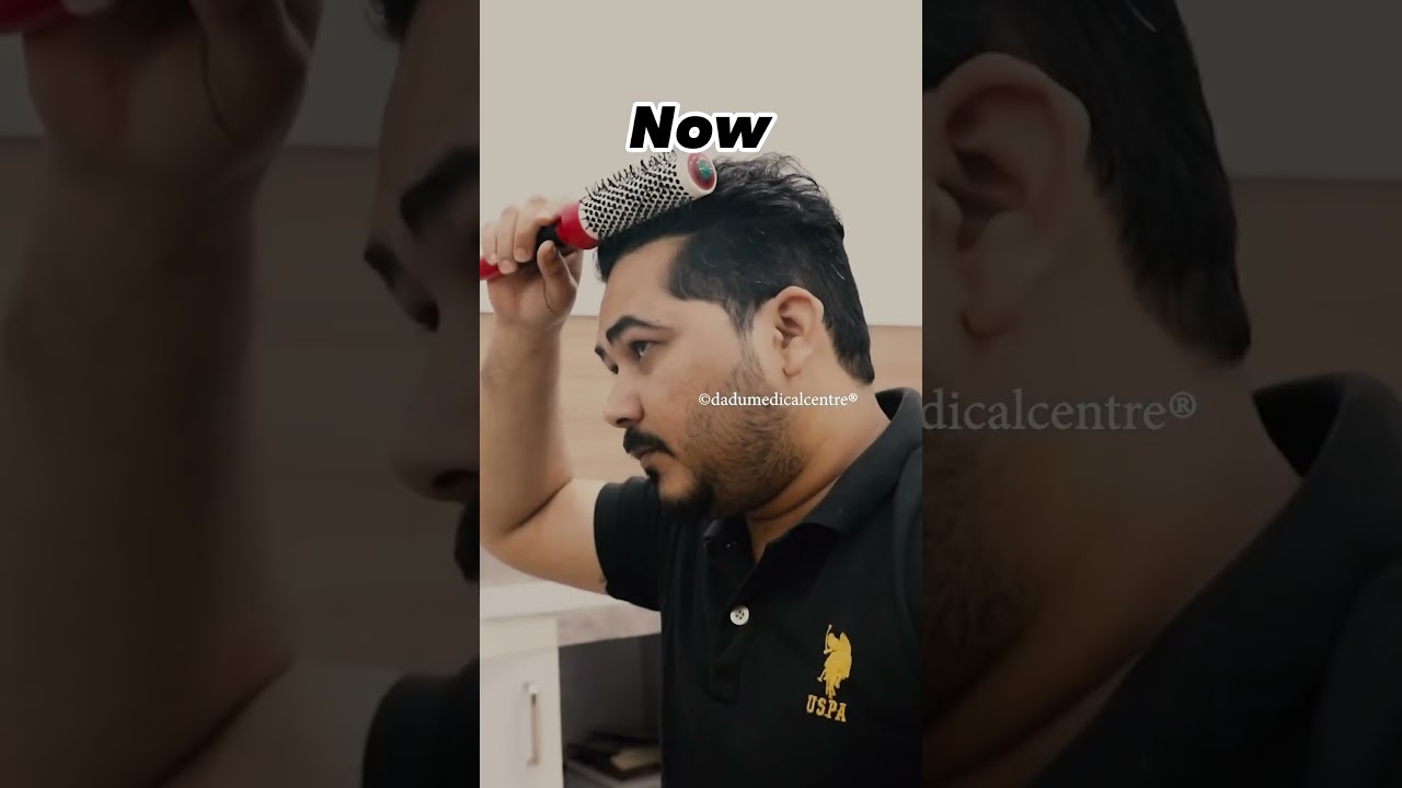 7 Months Hair Transplant Results  | Dadu Medical Centre