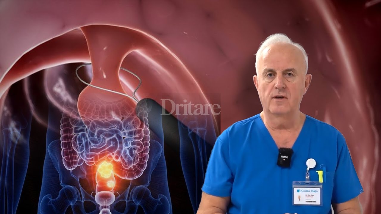 Kolonoskopia zbulon kancerin! Çfarë duhet të dini para se ta bëni! | Dritarja e Doktorit