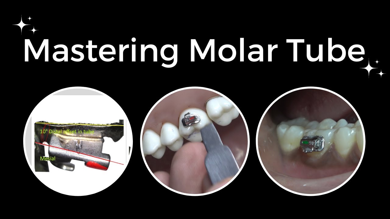Mastering Molar Tube Placement: Insights and Practical Guidance