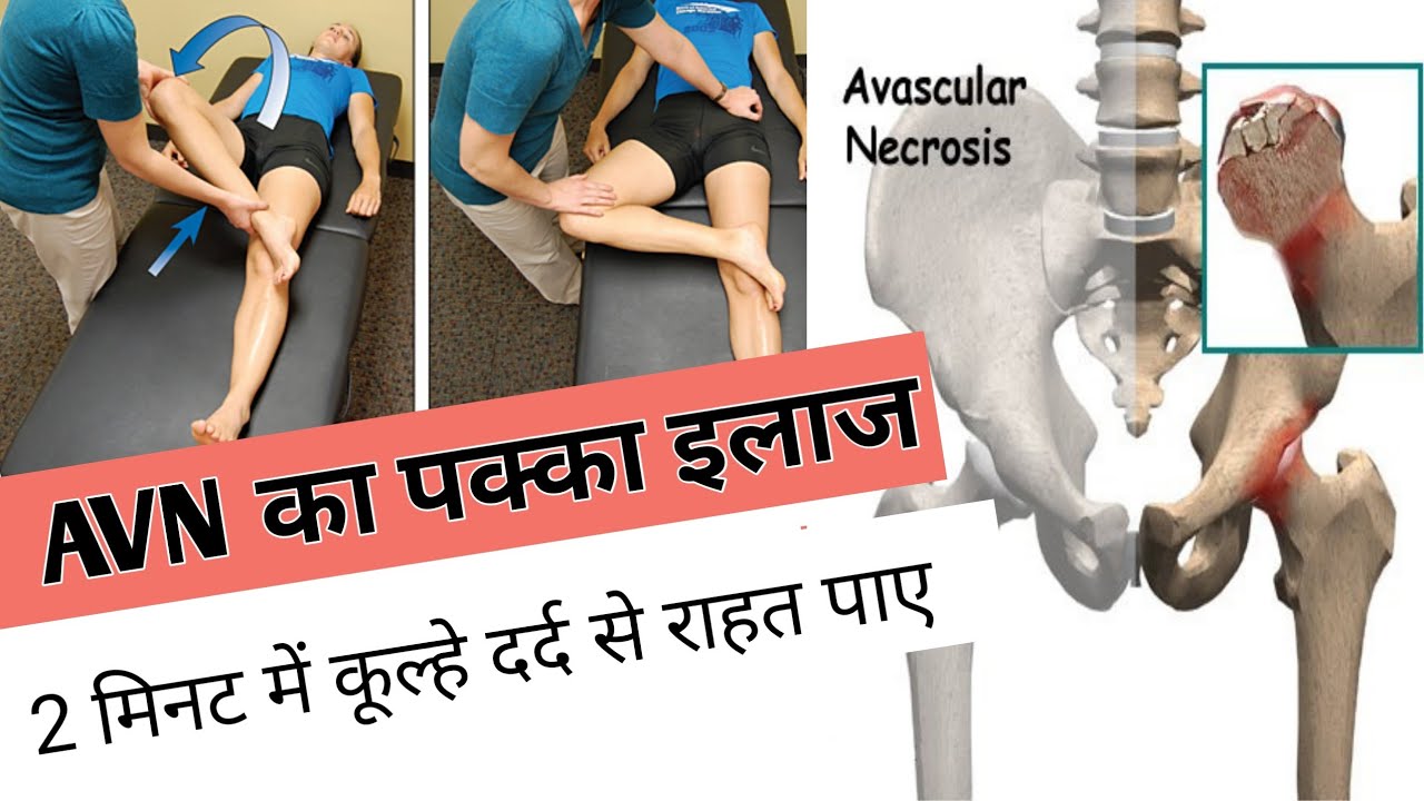 Best exercises for hip pain || avascular necrosis treatment without surgery in hindi, avn hip joint