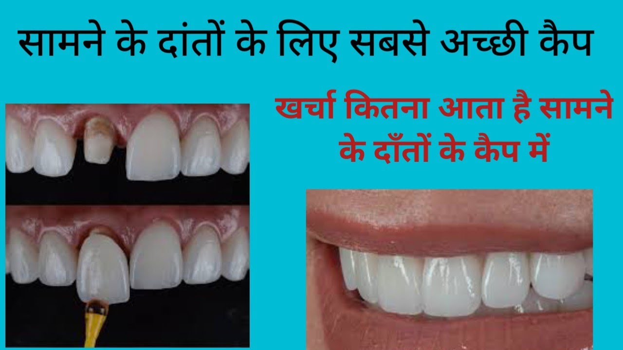 सामने के दांतों के लिए सबसे अछि कैप/कैप का खर्चा/Types of dental cap and cost//teeth cap/Dental cap