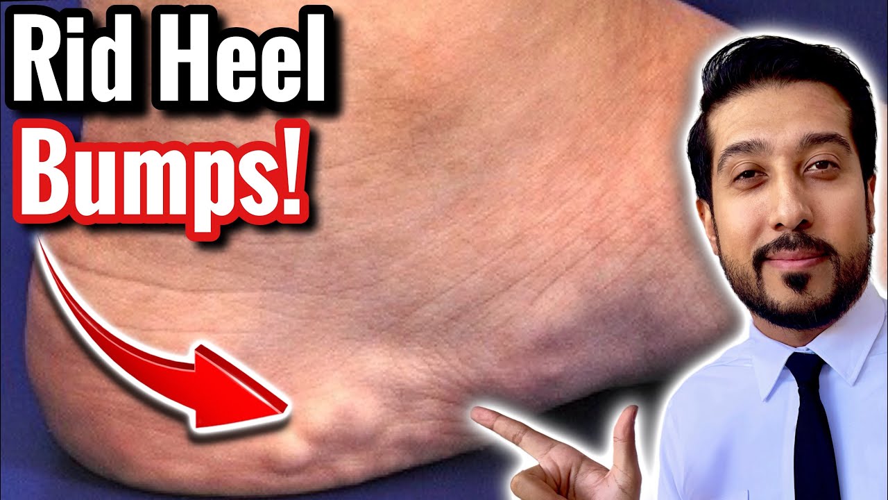 Mysterious Bumps on Heels | How to Get Rid of Piezogenic Papules