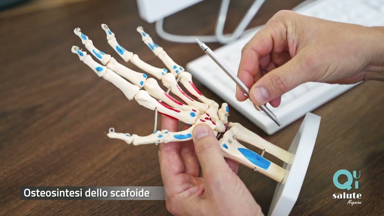Frattura dello scafoide: qual &egrave; la soluzione migliore?