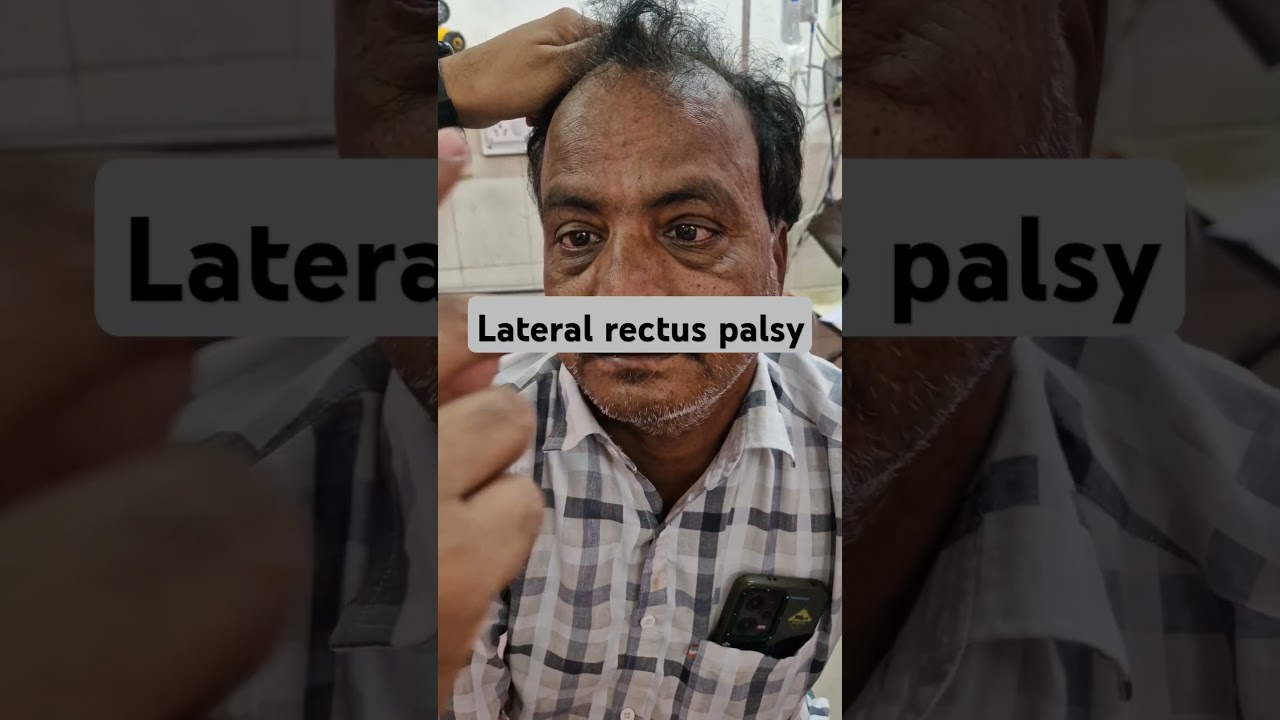 Lateral rectus muscle paralysis/CN 6th Nerve palsy#doctor  #ophthalmology#nervedisorders