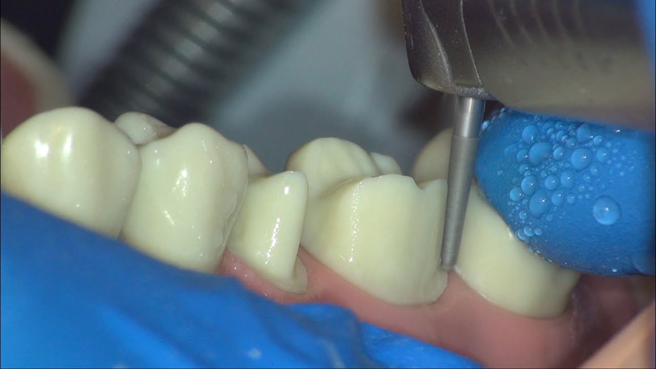 Crown Prep Tutorial | ACC 3, 4 | First Person Perspective