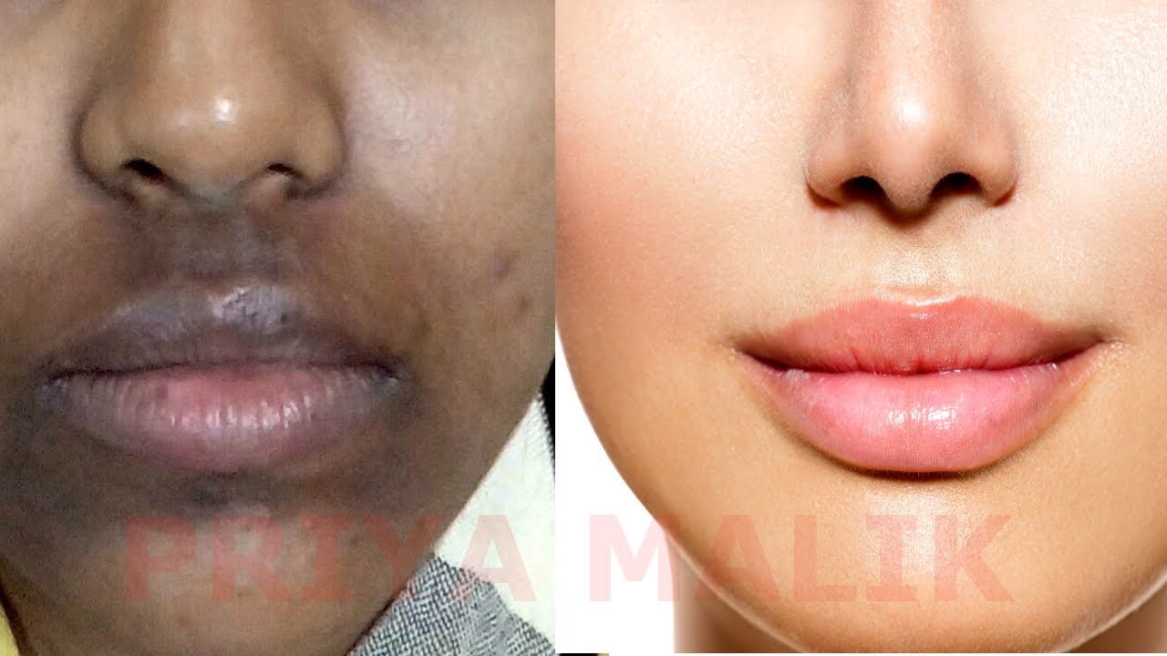 How To Remove Dark Black patches, Dark Spots,Hyper pigmentation, Around Your Mouth | PRIYA MALIK