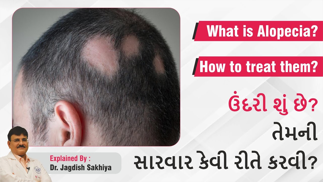 what is alopecia? how to treat them? (ઉંદરી શું છે? તેમની સારવાર કેવી રીતે કરવી?)
