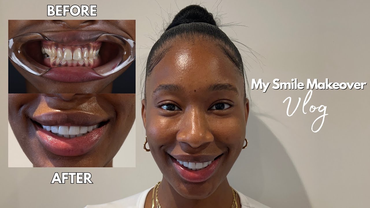 I GOT MY TEETH DONE IN TURKEY WITH MINIMAL SHAVING | The Process | Cost $$$ | SMILE MAKEOVER | Vlog