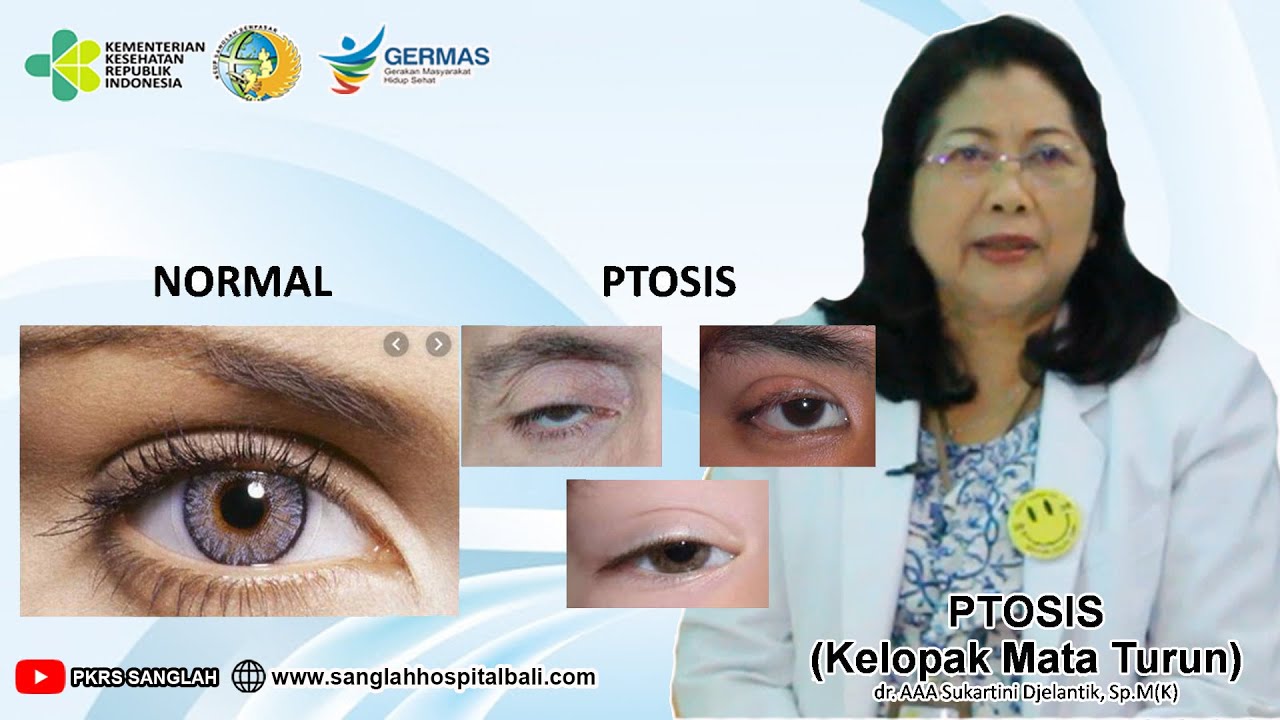 Jangan Meremehkan Kelopak Mata Turun (PTOSIS)!
