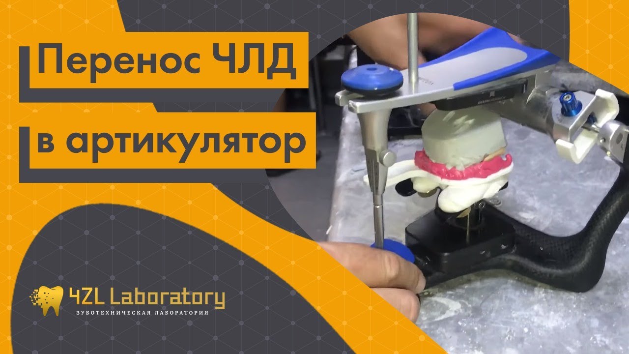 Перенос ЧЛД в артикулятор. Загипсовка моделей в артикулятор