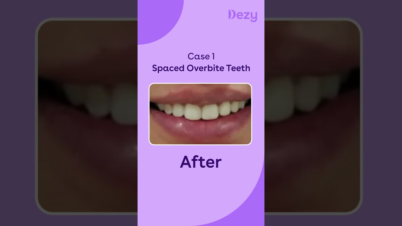 Clear Aligners Before and After Treatment Results | Transform Your Smile at Dezy