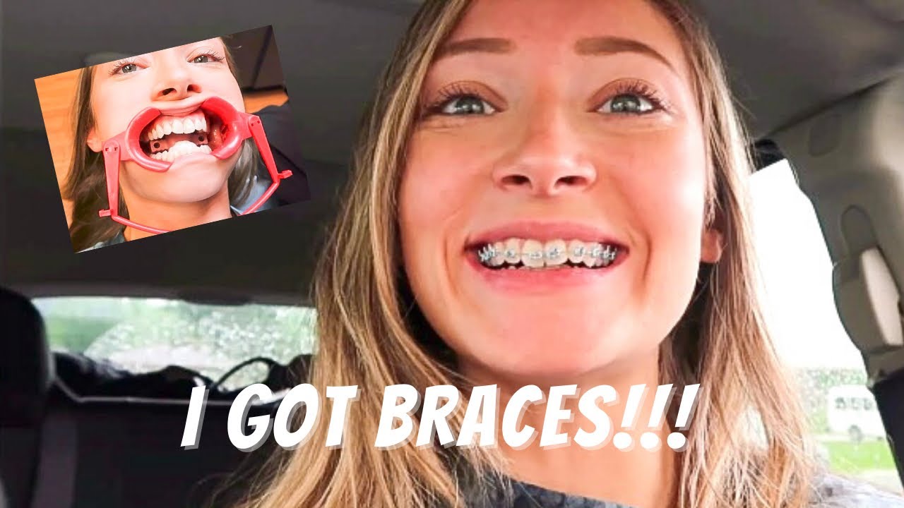 FINALLY GETTING BRACES ON!! VLOG 2023