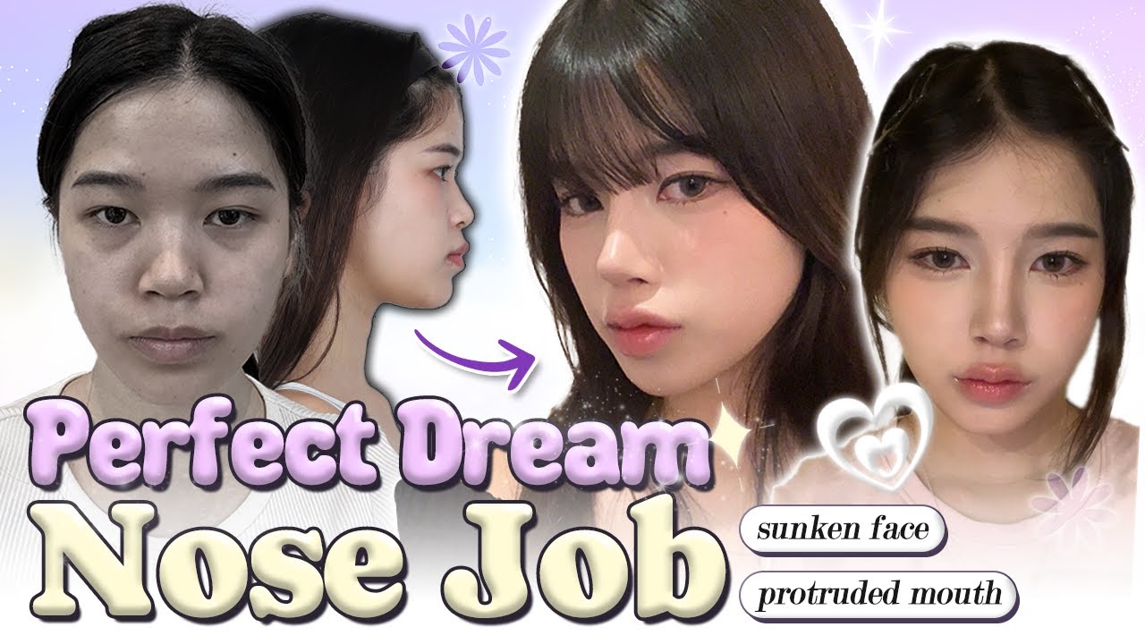 My rhinoplasty result shocked me😱😱😱 | Lilo's plastic surgery journey at BRAUN! (Part 2)
