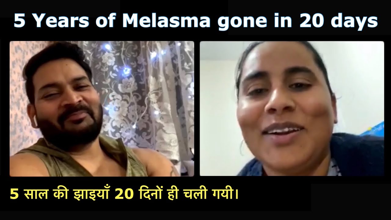 5 years of Melasma/Pigmentation gone in 20 days. 5 साल की झाइयाँ 20 दिनों ही चली गयी।