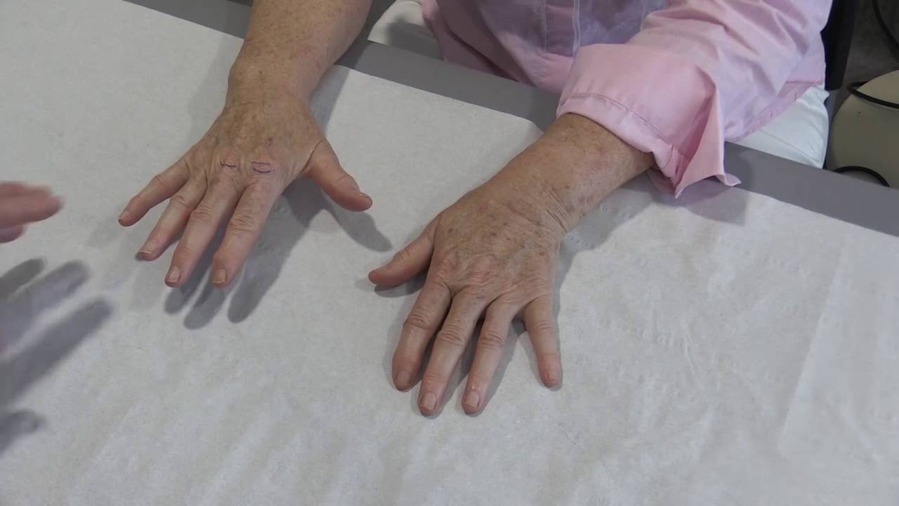 4- Examination of the arthritic hand
