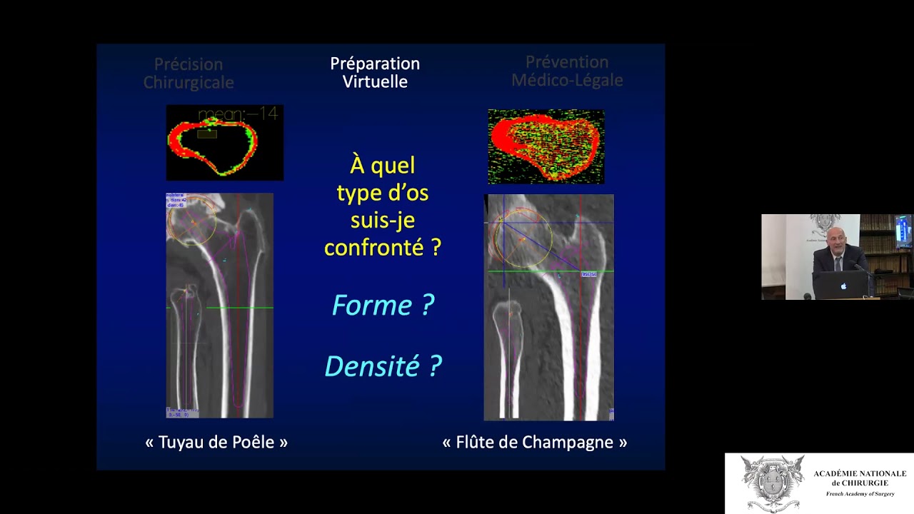 La planification en 3D des Prothèses Totales de Hanche