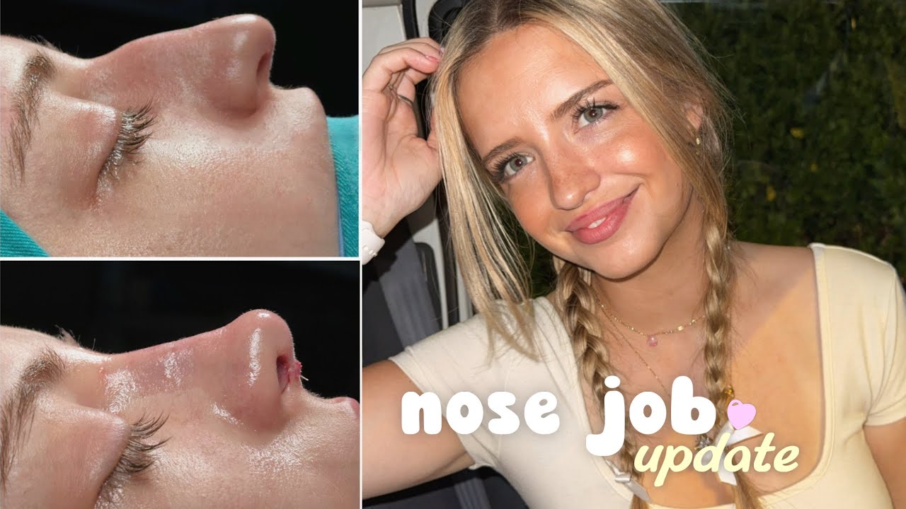 4 MONTHS POST-OP🩵 Turkey Nose Job Q&A✨