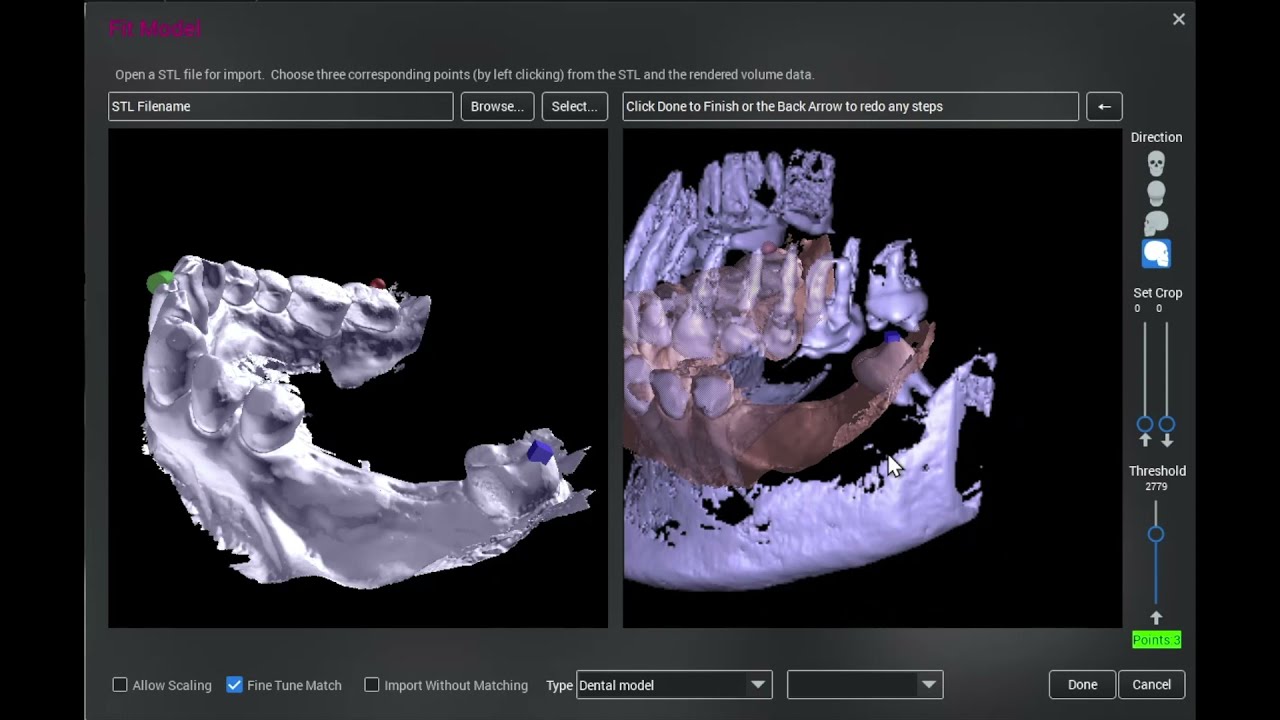 Difficult intraoral to CBCT merge for implant guide design:  Tips and Tricks in Planmeca Romexis