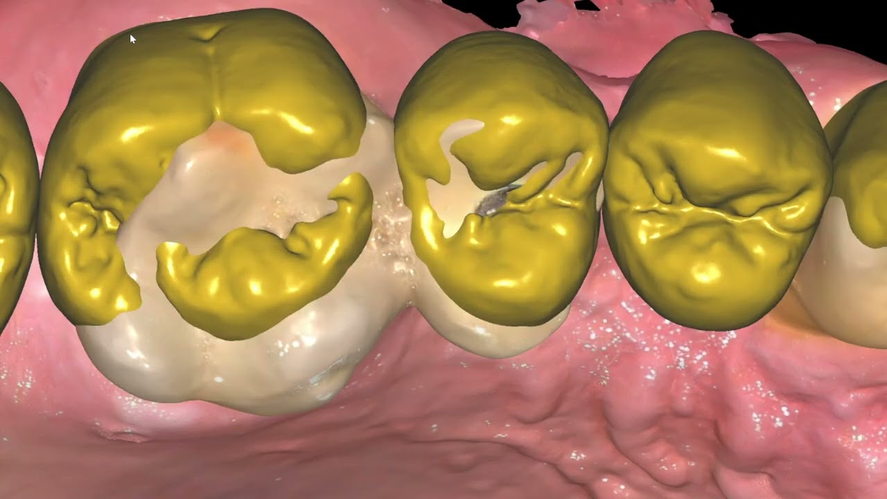 DIGITAL WAX-UP Full Mouth