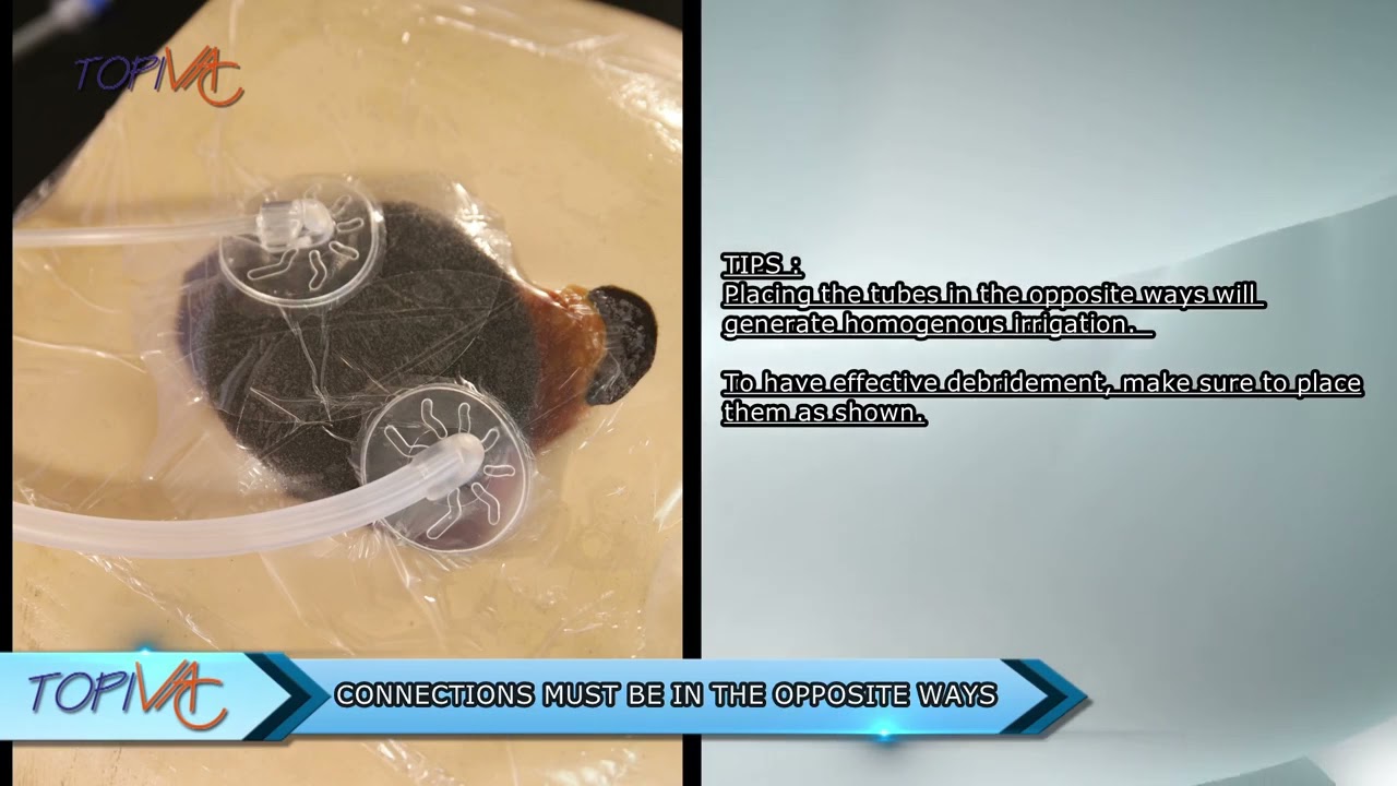 TopiVac T-NPWT Wound Care - Vacuum Therapy & Wound Irrigation Application