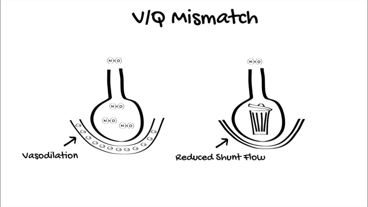 Inhaled Nitric Oxide in ICU